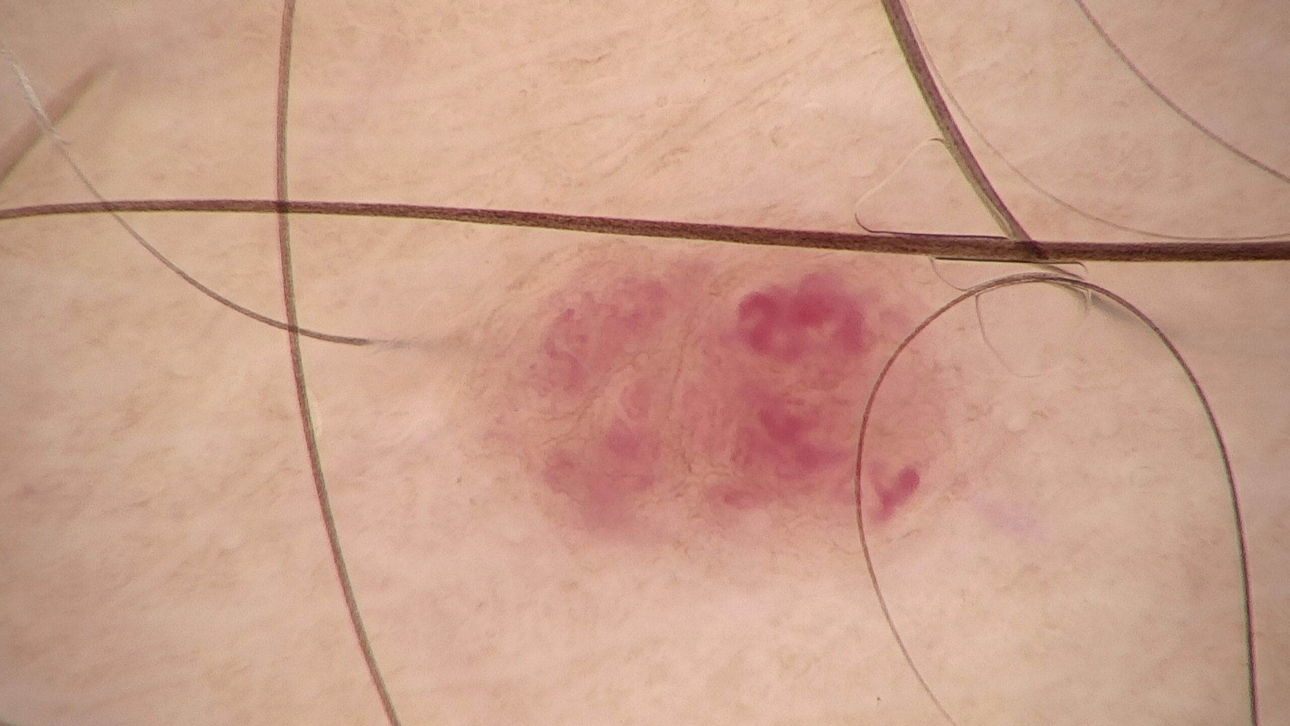 Extreme macro close up of capillaries on skin texture. Cherry Angioma or red mole under microscope.