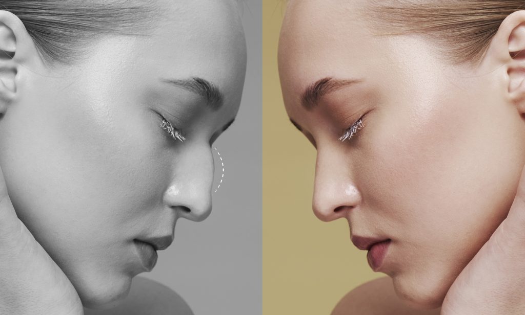 side view of a woman before and after rhinoplasty